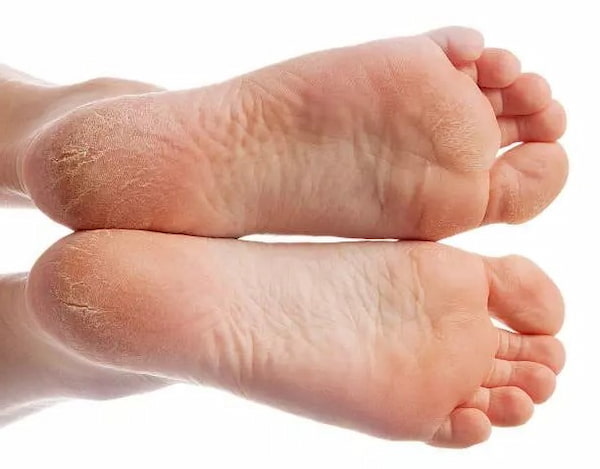 تصویر 5 از قیمت خرید کرم ترک پا گیاهی با فروش عمده