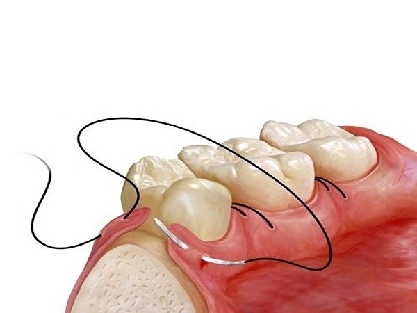 تصویر 1 از فروش نخ بخیه سیلک دندانپزشکی + قیمت خرید به صرفه