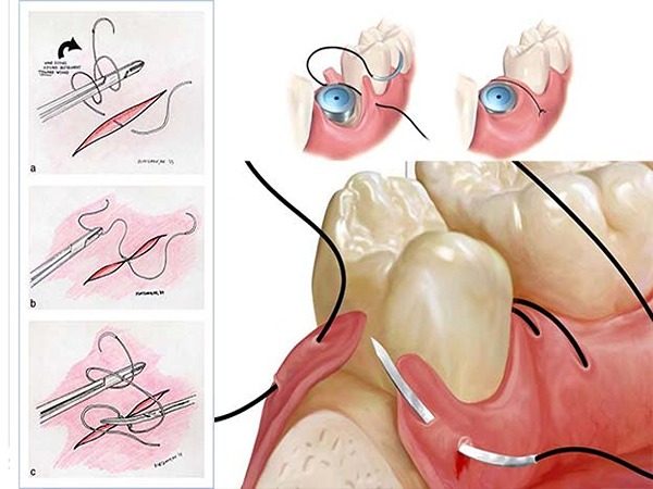 تصویر 5 از فروش نخ بخیه سیلک دندانپزشکی + قیمت خرید به صرفه