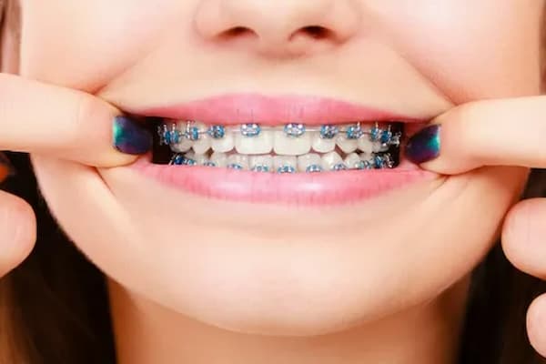 تصویر 2 از خرید و قیمت اورینگ ارتودنسی بنفش + فروش عمده