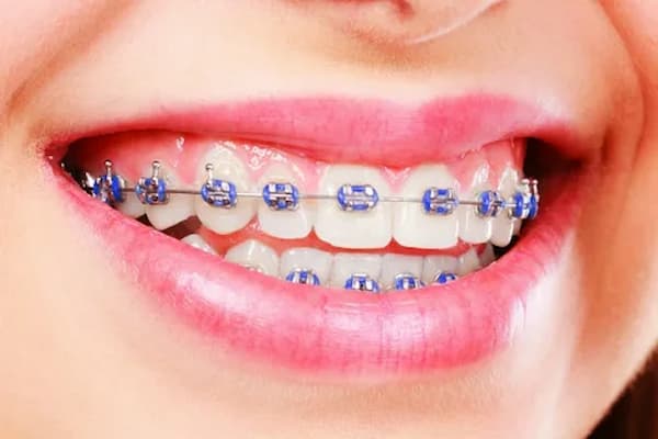 تصویر 3 از خرید و قیمت اورینگ ارتودنسی بنفش + فروش عمده