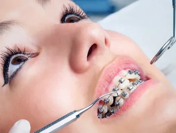 تصویر 5 از خرید و قیمت اورینگ ارتودنسی بنفش + فروش عمده