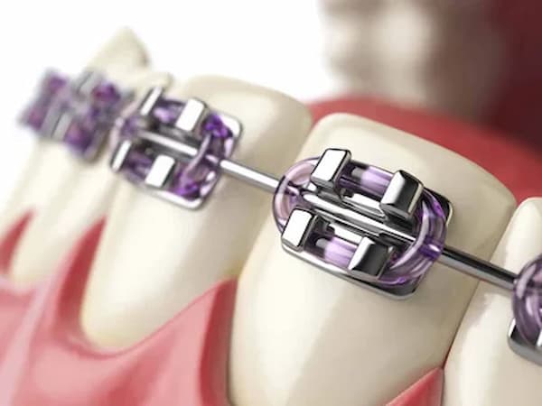 تصویر 4 از خرید ارتودنسی فک بالا + قیمت فروش استثنایی