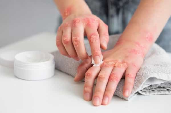 تصویر 2 از قیمت وازلین ضد قارچ + خرید باور نکردنی