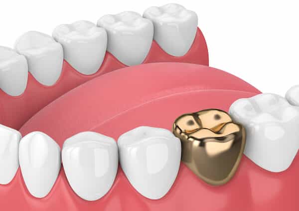 تصویر 4 از قیمت روکش دندان طلا + خرید باور نکردنی
