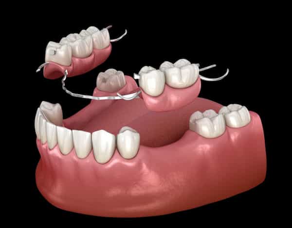 تصویر 1 از قیمت خرید دندان متحرک کامپوزیت + فروش ویژه