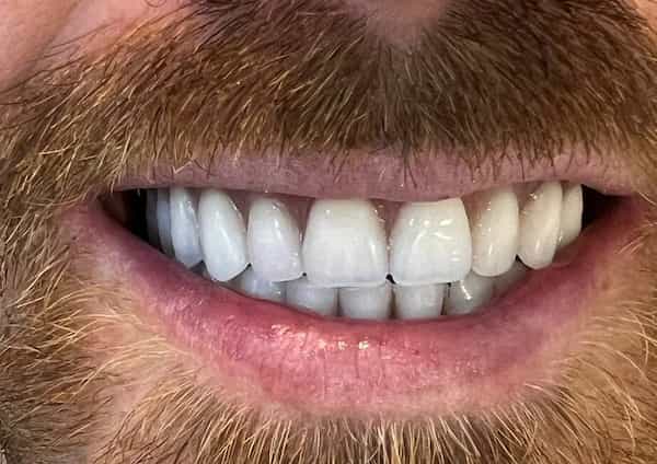 تصویر 4 از قیمت خرید دندان متحرک کامپوزیت + فروش ویژه